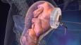 Epidural 2
