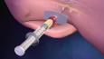Epidural 4