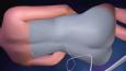 Epidural 7