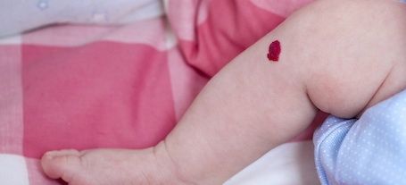 El angioma en la piel del bebé