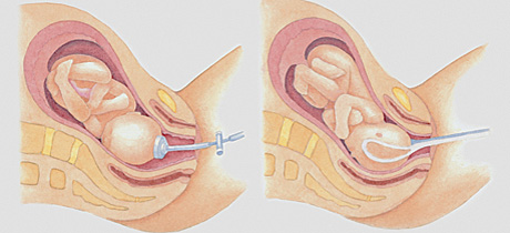 El uso de fórceps y ventosas en el parto