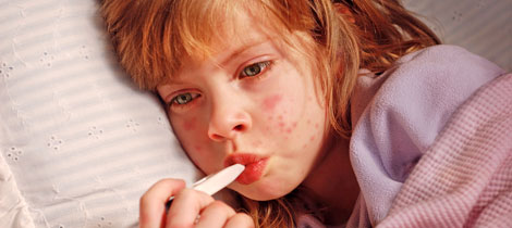 Síntomas del lupus en niños