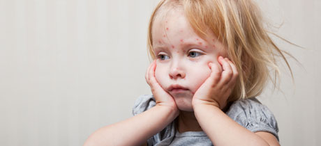 Alergias alimentarias en niños y bebés