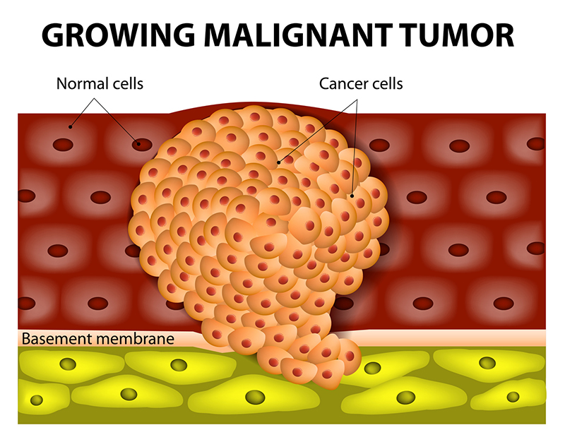 2. Los tumores benignos y malignos