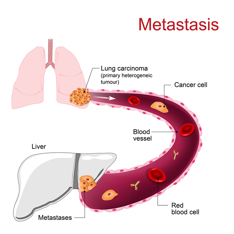 4. ¿Qué es el cáncer?