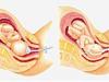 El uso de fórceps o ventosas en el parto