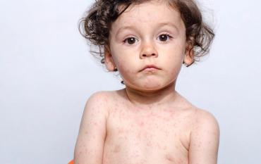 Enfermedades comunes del bebé: sarampión