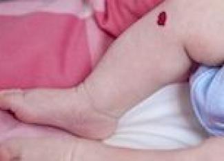 El angioma en la piel de un bebé