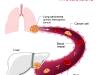 4. ¿Qué es el cáncer?