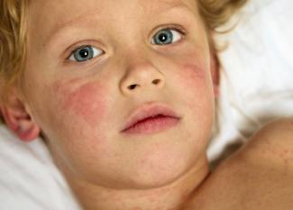 Urticaria en niños