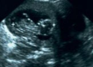 Desarrollo fetal en la semana 5 de embarazo