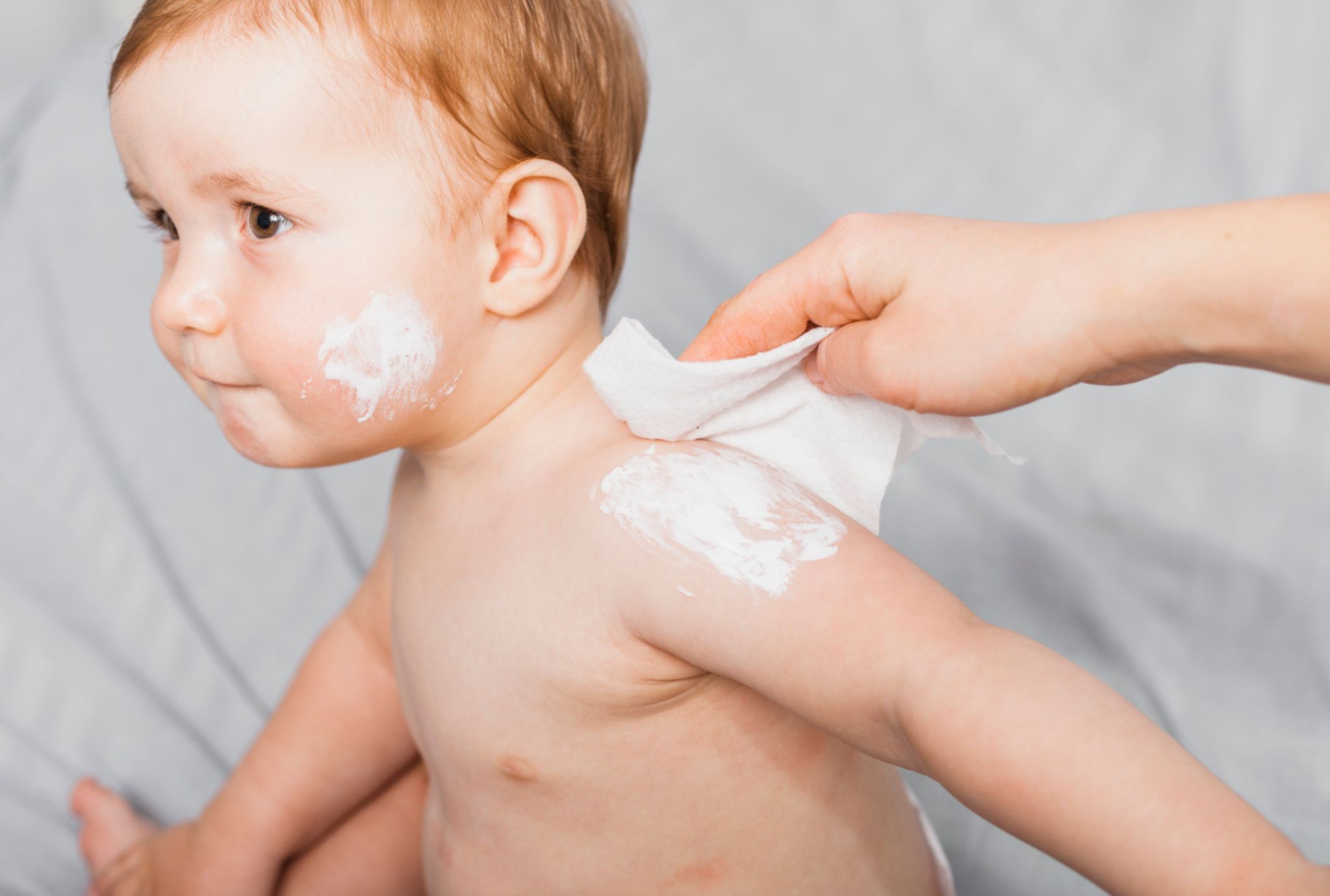 dermatitis en bebés