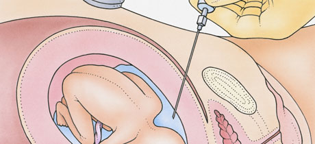 Amniocentesis y triple screening en el embarazo