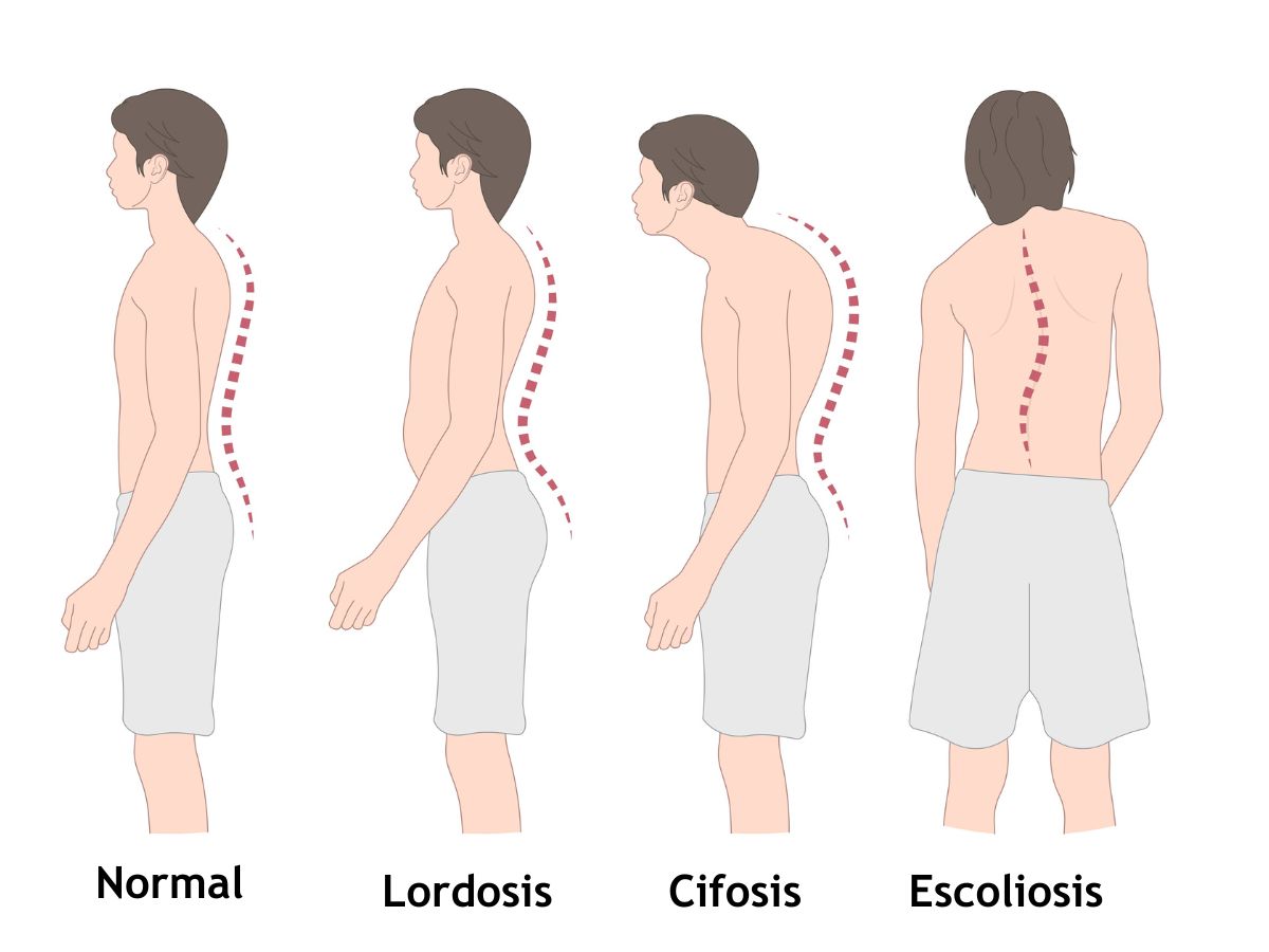 escoliosis y cifosis