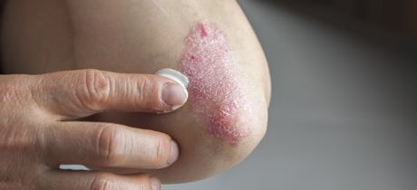 psoriasis